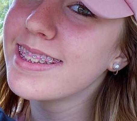 Cum on teen braces