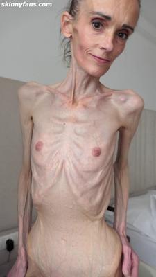 Denisa anorexique maigre maigre mageur Duenn Knochig Bones