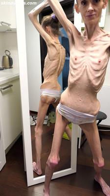 Denisa anorexique maigre maigre mageur Duenn Knochig Bones
