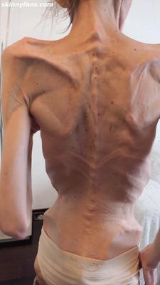 Denisa anorexic skinny fragile mager duenn knochig bones 